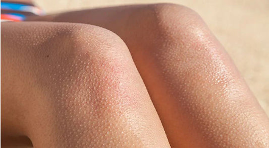 Rough skin? Understanding Keratosis Pilaris and Its Treatment