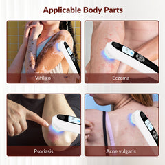ZJZK 308nm UVB Light Therapy Device Professional Treatment for Skin Diseases