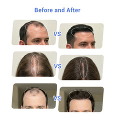 ZJZK Laser Cap — Reverse Hair Loss by Restoring Blood Flow & Energy to Your Follicles
