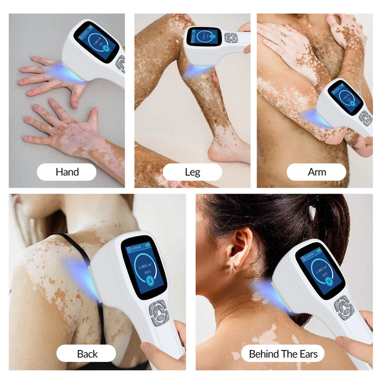 308nm for Skin Diseases – ZJZK Shop