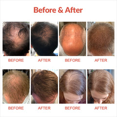 ZJZK Laser Cap - FDA Cleared Hair Laser Growth Treatment for Men & Women - Thinning Hair, Spot or Full Scalp, Denser/Fuller Hair, Medical Grade Laser